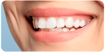 Faccette estetiche dentali