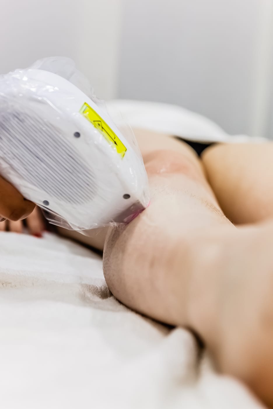 epilazione laser
