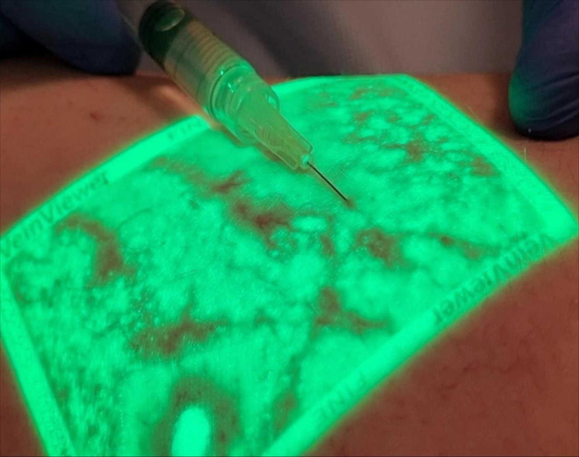 Scleroterapia con Veinviewer