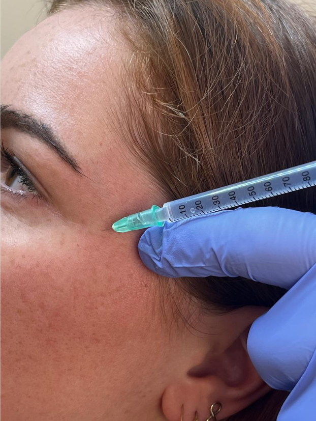 Immagine Bioevitalizzazione viso