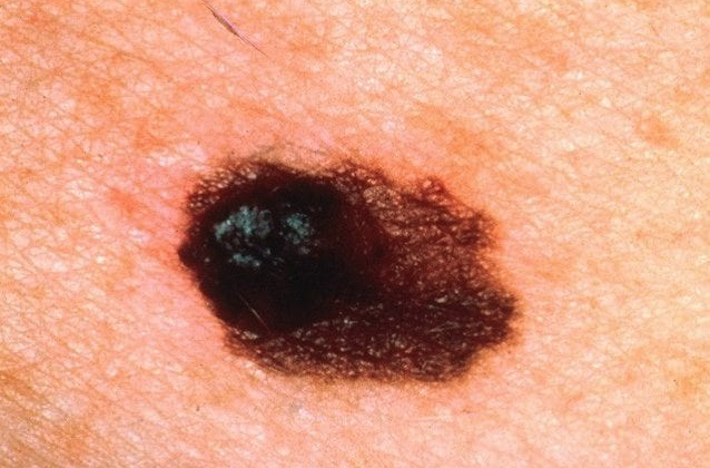 immagine Melanoma