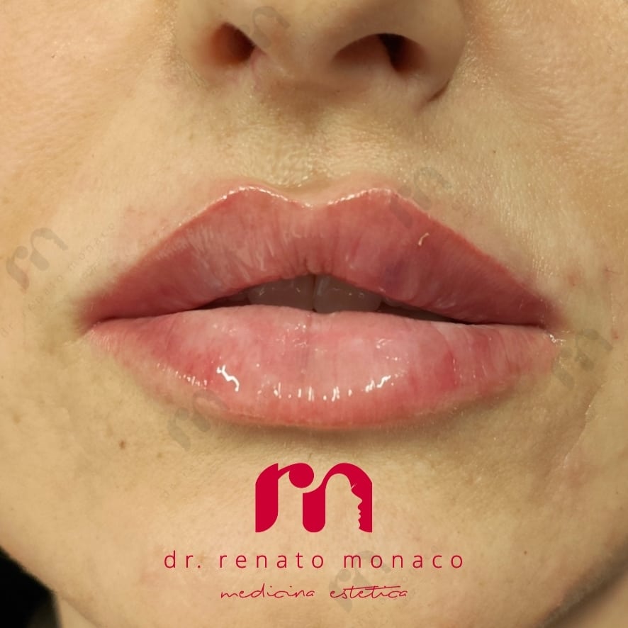 foto cliente trattamento labbra
