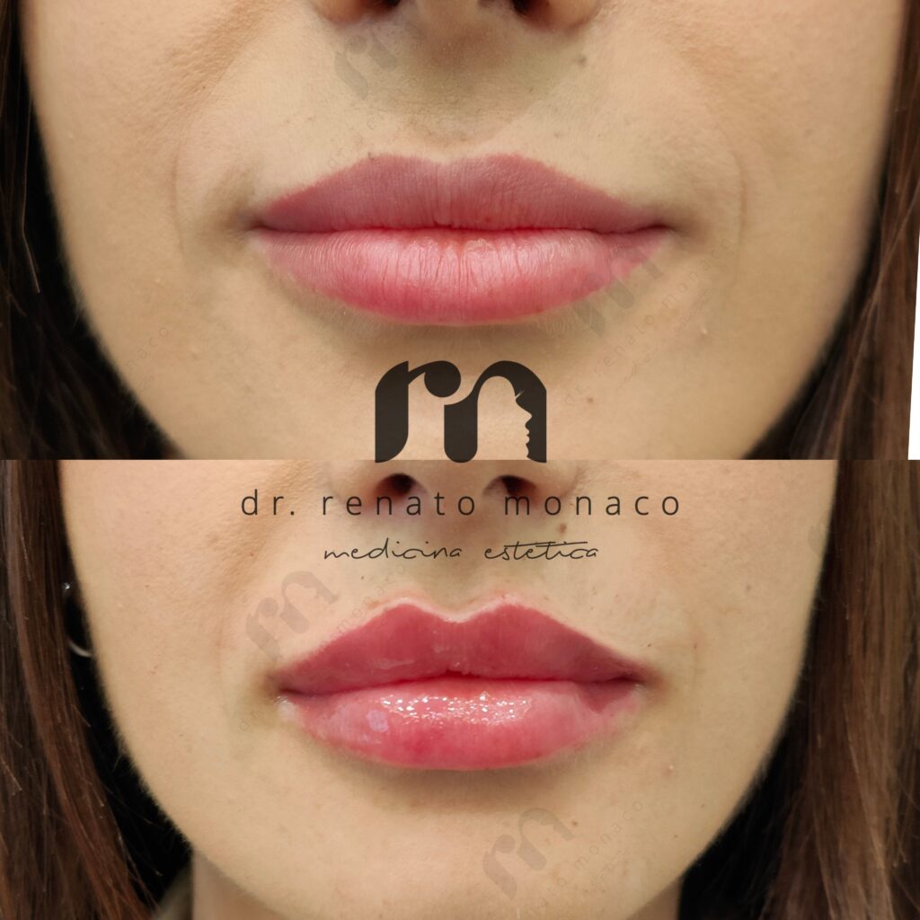 foto cliente trattamento labbra prima e dopo